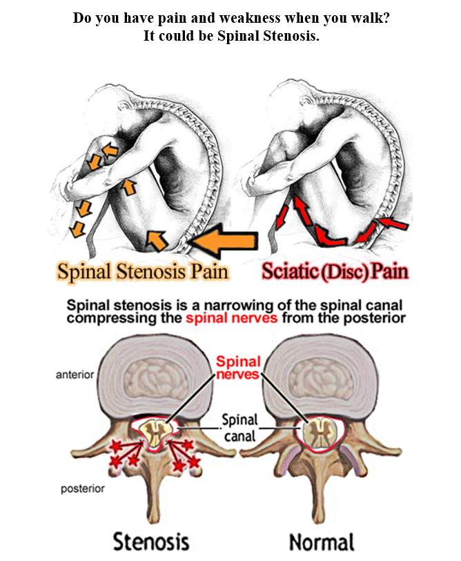 Spinal Stenosis